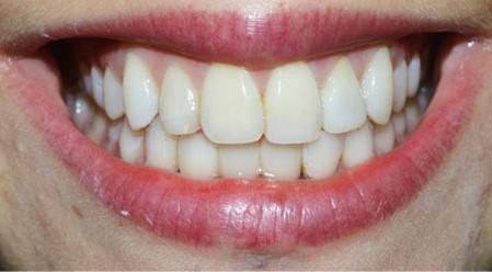 Dental Implant After